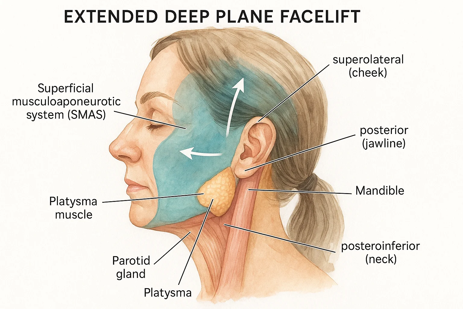 Extended deep plane facelift dissection area and lift vectors shown on facial anatomy profile view